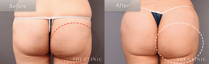 お尻の失敗修正の術前・術後の症例写真