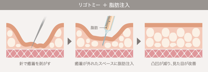 リゴトミー + 脂肪注入