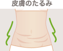 皮膚のたるみ