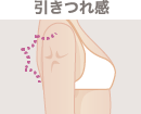 引きつれ感