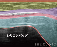 シリコンバッグ破損