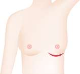 一般的な切開箇所1