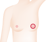 一般的な切開箇所2