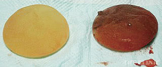 抜去したバッグの報告1