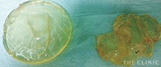 抜去したバッグの報告2