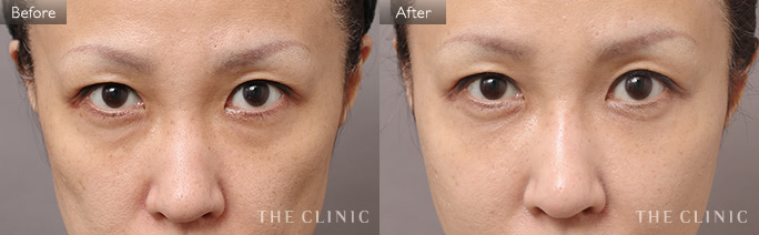 目の下のクマ改善のためのSRF注入(顔の脂肪注入)の症例