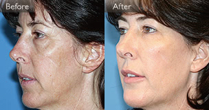 脂肪を活用したアメリカの症例1