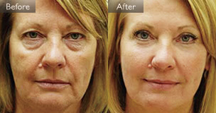 脂肪を活用したアメリカの症例2