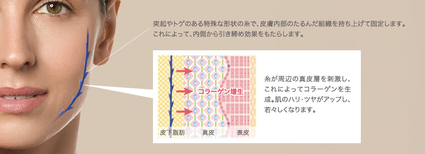 突起やトゲのある特殊な形状の糸で、皮膚内部のたるんだ組織を持ち上げて固定します。 これによって、内側から引き締め効果をもたらします。 / 糸が周辺の真皮層を刺激し、これによってコラーゲンを生成。肌のハリ・ツヤがアップし、若々しくなります。