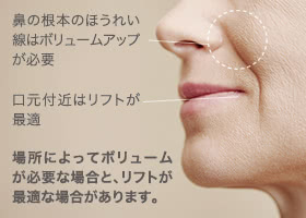 鼻の根本のほうれい線はボリュームアップが必要 / 口元付近はリフトが最適 場所によってボリュームが必要な場合と、リフトが最適な場合があります。