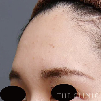 おでこ(額)のくぼみのコンデンスリッチフェイス(顔の脂肪注入)のモニター 術前症例画像