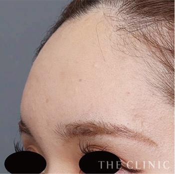 おでこ(額)のくぼみのコンデンスリッチフェイス(顔の脂肪注入)のモニター 術後症例画像