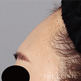 おでこ(額)のくぼみのコンデンスリッチフェイス(顔の脂肪注入)のモニター(20代)術前症例画像