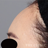 おでこ(額)のくぼみのコンデンスリッチフェイス(顔の脂肪注入)のモニター(20代)術後症例画像