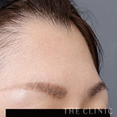 おでこ(額)のくぼみのコンデンスリッチフェイス(顔の脂肪注入)のモニター(40代)術前症例画像