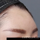 おでこ(額)のくぼみのコンデンスリッチフェイス(顔の脂肪注入)のモニター(40代)術後症例画像