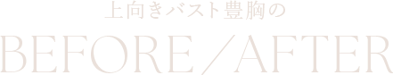 上向きバスト豊胸のBefore／After