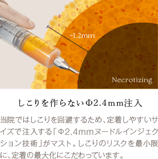 担当医によるプラしこりを作らないΦ2.4mm注入ン提案
