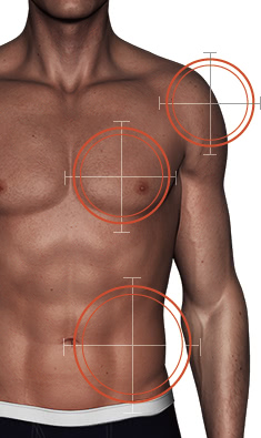 上腕へのベイザー4Dスカルプト / 胸部へのベイザー4Dスカルプト / 腹部へのベイザー4Dスカルプト