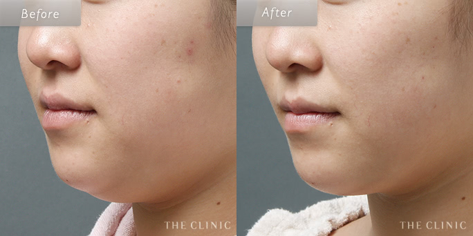 頬・顎のベイザー脂肪吸引症例(23歳/女性)