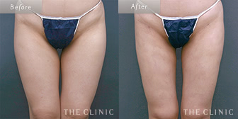 太もものベイザー脂肪吸引症例(41歳/女性)