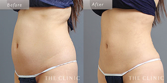 腹部のベイザー脂肪吸引症例(24歳/女性)