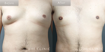 女性化乳房のベイザー脂肪吸引症例(26歳/男性)