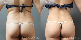 背中・腰のベイザー脂肪吸引症例(50歳/女性)