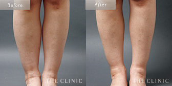 ふくらはぎのベイザー脂肪吸引症例(45歳/女性)