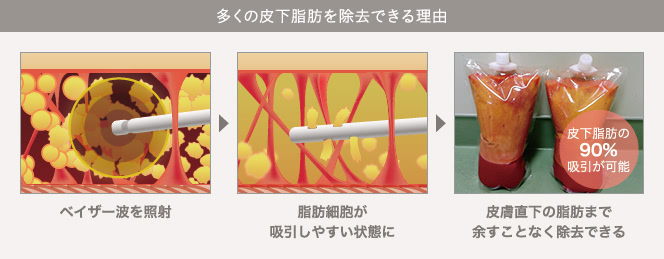 多くの皮下脂肪を除去できる理由 | ベイザー波を照射 / 脂肪細胞が吸引しやすい状態に / 皮膚直下の脂肪まで余すことなく除去できる(皮下脂肪の90%吸引が可能)