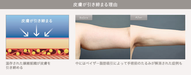 従来法: 先端が鋭利なカニューレで脂肪組織を切り崩す / ベイザー: カニューレが周辺組織を傷つけないから、術後の回復が早い