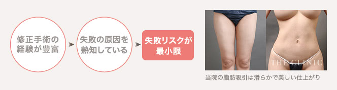 修正手術の経験が豊富 / 失敗の原因を熟知している / 失敗リスクが最小限 | 当院の脂肪吸引は滑らかで美しい仕上がり