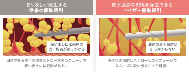 取り残しが発生する従来の脂肪吸引: 吸い出し口に固体の皮下脂肪が引っかかる / 固体である皮下脂肪をストロー状のカニューレで吸い出すには限界がある。 | 皮下脂肪の90%を除去できるベイザー脂肪吸引: 液体の皮下脂肪は引っかからない / 液体状の脂肪はストロー状のカニューレでスムーズに吸い出すことが可能。