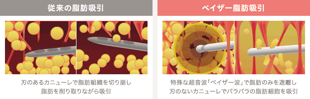 従来の脂肪吸引: 先端が鋭利なカニューレで脂肪組織を切り崩し脂肪を削り取りながら吸引 | ベイザー脂肪吸引: 特殊な超音波「ベイザー波」で脂肪のみを遊離し刃のないカニューレでバラバラの脂肪細胞を吸引