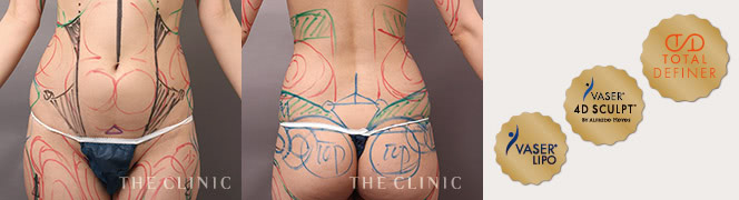 「VASER Lipo」「VASER 4D SCULPT」「Total Definer」