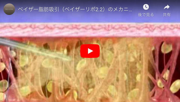 ベイザーリポ（ベイザー脂肪吸引）のメカニズム