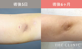 術後5日 / 術後6ヶ月