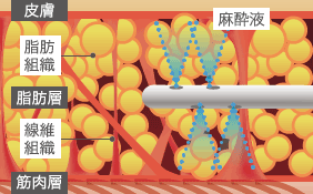 皮膚 / 皮膚 / 脂肪層 / 線維組織 / 筋肉層 / 麻酔液