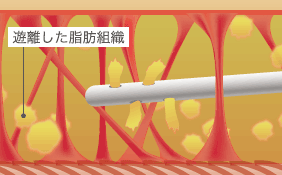 遊離した脂肪組織