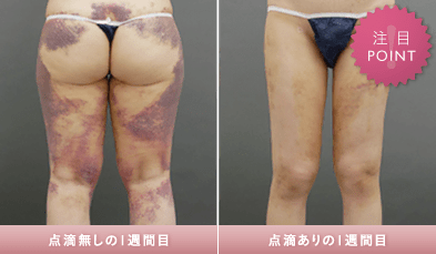 脂肪吸引術後の専用コスメ「ダウンタイム」のクリームとローション