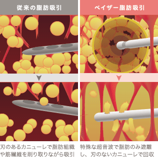 従来の脂肪吸引とベイザー脂肪吸引との吸引工程の違い
