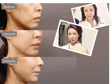 ファットバンクを用いたエイジング治療の経過写真