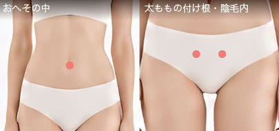 お腹の脂肪吸引の傷の位置（おへその中・太ももの付け根・陰毛内）