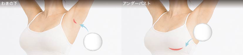 ハイブリッド豊胸の傷の位置（わきの下・アンダーバスト）