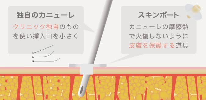 独自のカニューレとスキンポート