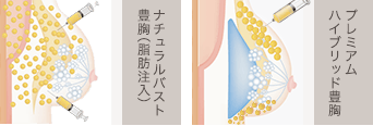 ナチュラルバスト豊胸とプレミアムハイブリッド豊胸
