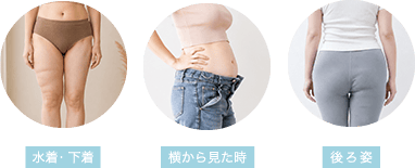 脂肪吸引の仕上がりでバレやすい場面（水着・下着、横から見た時、後ろ姿）
