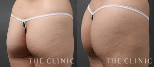 4DLipo（4Dリポ）モニターの症例画像｜THE CLINIC