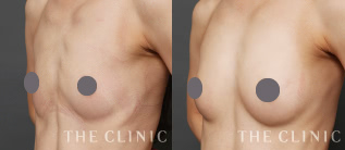 BEbra×コンデンスリッチ豊胸モニターの症例画像｜THE CLINIC