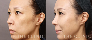 TV紹介記念モニターの症例画像｜THE CLINIC